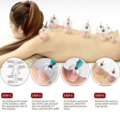 Bộ giác hơi 12 món không dùng lửa (cao cấp) Giúp giảm các chứng đau lưng; đau đầu; cảm cúm; nhức mỏi