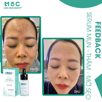 SERUM NGỪA MỤN THÂM - MỜ SẸO 25ML - MOC