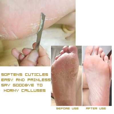 Bộ 3 Dao Lấy Khóe Móng Nhặt Da Khóe, Cắt Móng Gãy, Cạo Da Chai Sần, Loại Bỏ Da Chai Sần Ở Lòng Bàn Chân