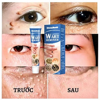 HỘP KEM TRỊ HẾT MỤN CÓC NÚT RUỒI DA THÂM SẠM LOẠI TỐT