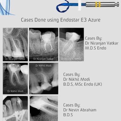 Trâm file nội nha từ châu Âu EndoStar E3 Azure-file dẻo